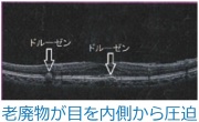 老廃物が目を内側から圧迫