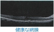 健康な網膜